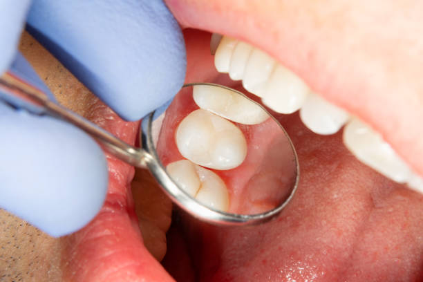 Cracked Tooth Repair Naperville